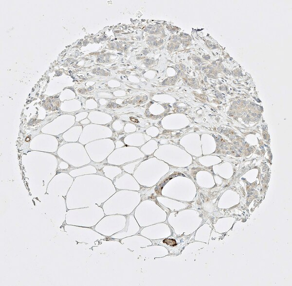 IHC of breast cancer cells labeled with DSHB antibody CPTC-CRP-1 against C-Reactive Protein Peptide 1. Image Credit: NCI-Clinical Proteomic Technologies for Cancer.